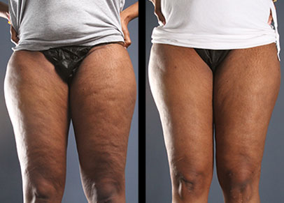 Cellulite Causes & Treatments  Restore SD Plastic Surgery in San