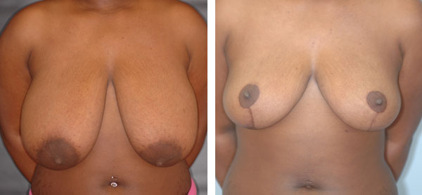 Breast_Lift_Reduction_BarryHandlerMD_1