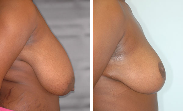 Breast_Lift_Reduction_BarryHandlerMD_2