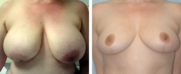 Breast_Lift_Reduction_BarryHandlerMD_3