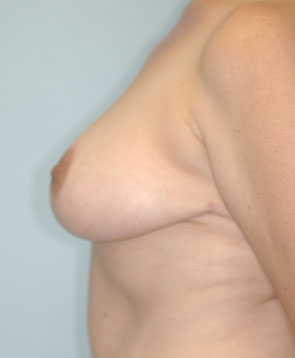 Breast_Lift_Reduction_BarryHandlerMD_4