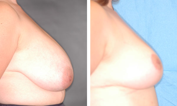 Breast_Lift_Reduction_BarryHandlerMD_6