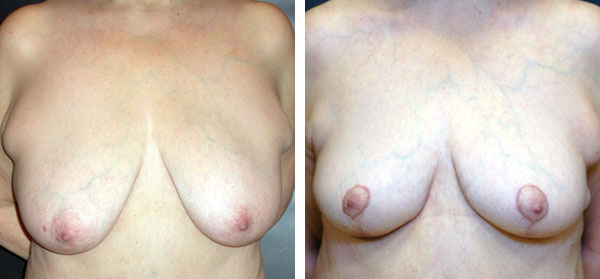 Breast_Lift_Reduction_BarryHandlerMD_7