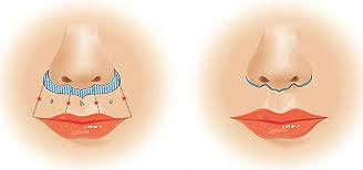 lip lift procedure